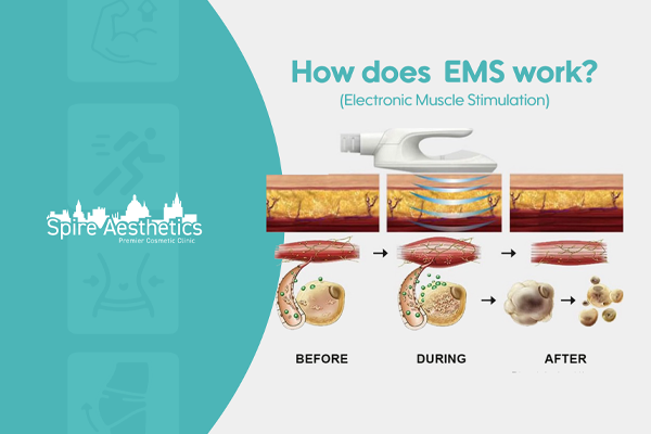 EMS treatment for post pregnancy weight loss treatment St Helens