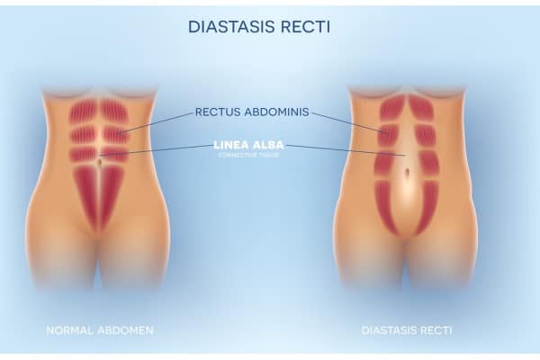What Non-Surgical Options Are Available for Diastasis Recti St Helens?