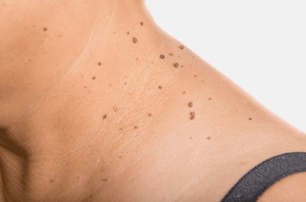 Are you looking for easy skin tag removal St Helens - then contact Spire today!