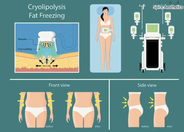Fat freezing treatment St Helens benefits for competitions to remove stubborn fat deposits.