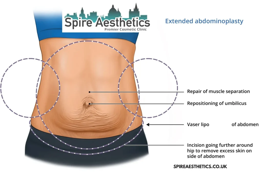 Understanding Loose Skin After Gastric Band St Helens Surgery and HIFU Treatment