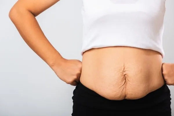 Image of a woman's stomach after weight loss with sagging skin following a gastric band St Helens