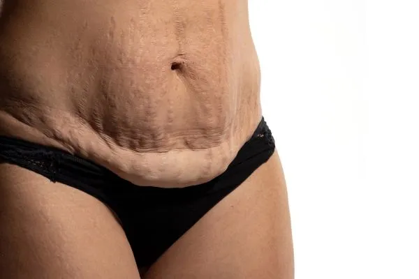 Image of womans stomach after weight loss injections St Helens showing saggy skin