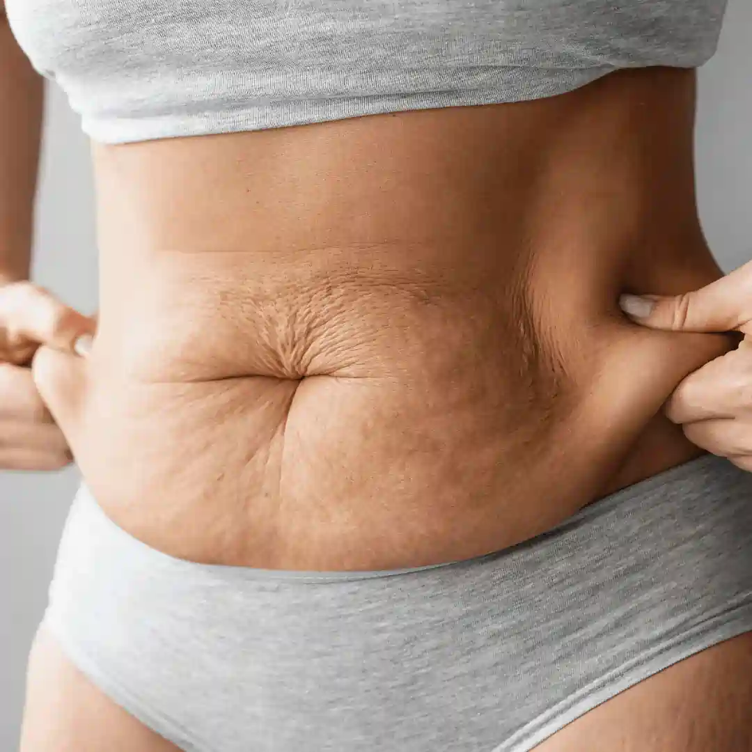Is It Normal to Have Loose Skin After Pregnancy St Helens?